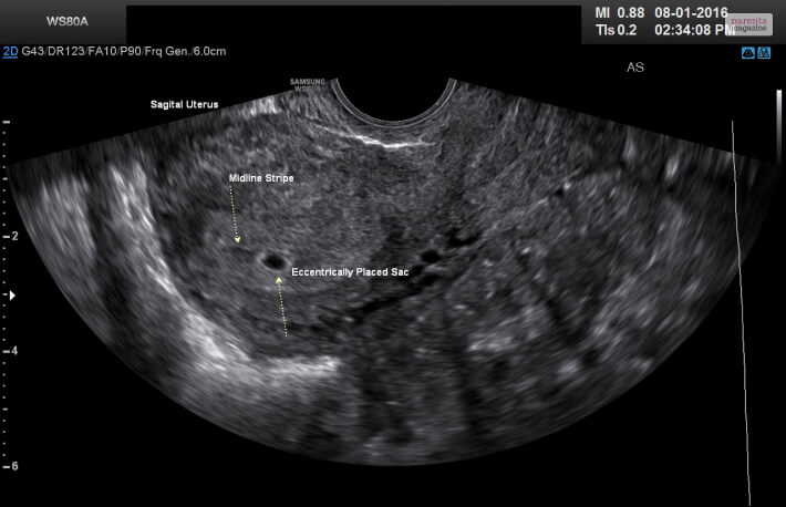 ultrasound-of-a-5-week-pregnancy