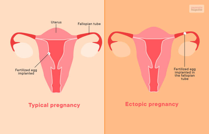 Ectopic Pregnancy