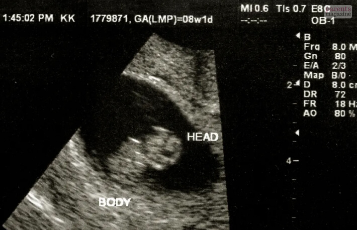 Ultrasound At 8 Weeks Pregnant Why Is It Important