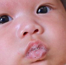 Understanding and Treating Drool Rash in Babies A Comprehensive Guide