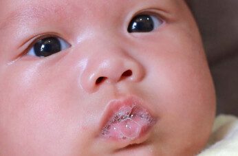 Understanding and Treating Drool Rash in Babies A Comprehensive Guide