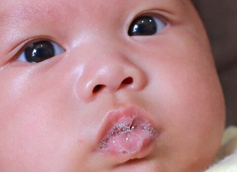 Understanding and Treating Drool Rash in Babies A Comprehensive Guide