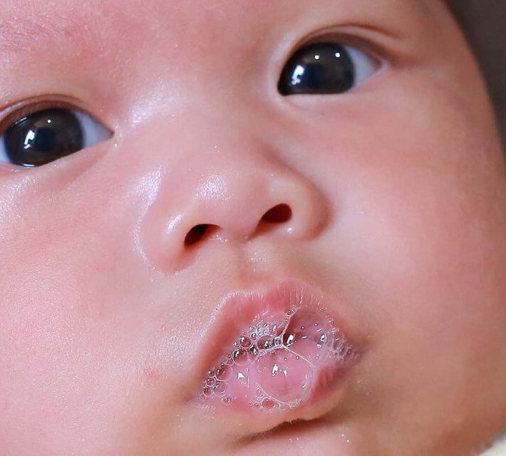 Understanding and Treating Drool Rash in Babies A Comprehensive Guide