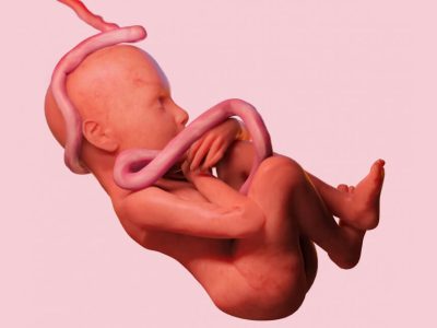 Anterior placenta