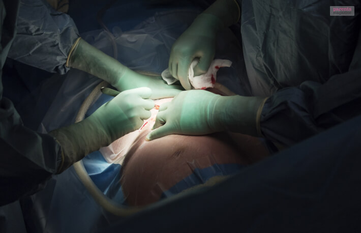 C-Section Surgery