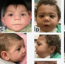 Syndrome In Babies