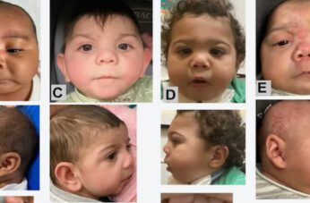 Syndrome In Babies