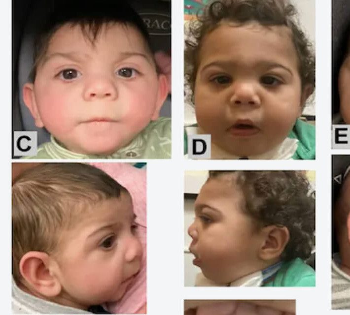 Syndrome In Babies