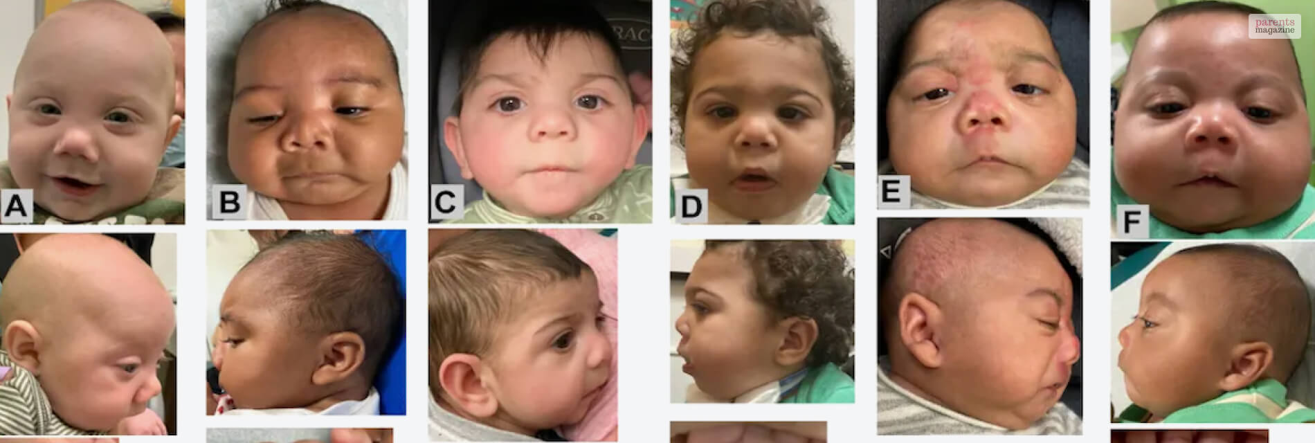 Syndrome In Babies