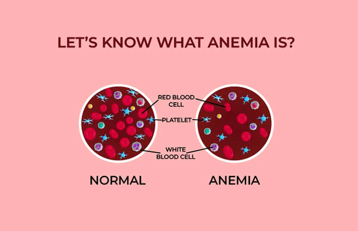 let’s know what anemia is 