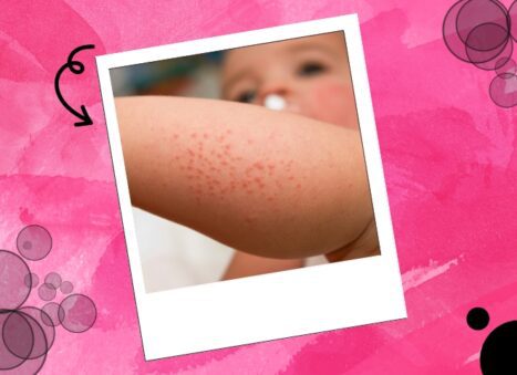 When to Worry About Rash on kids