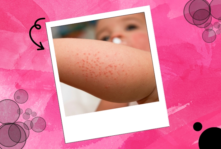 When to Worry About Rash on kids