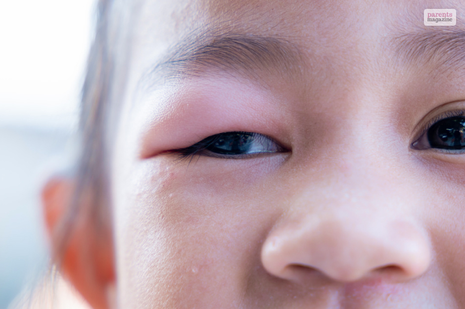 Cellulitis of the Eye