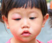 toddler woke up with swollen eye