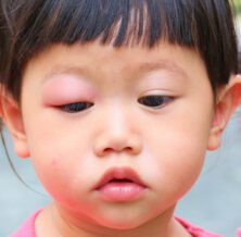 toddler woke up with swollen eye