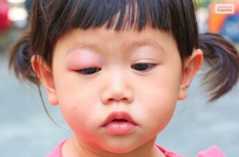 toddler woke up with swollen eye