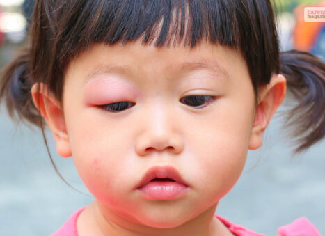 toddler woke up with swollen eye