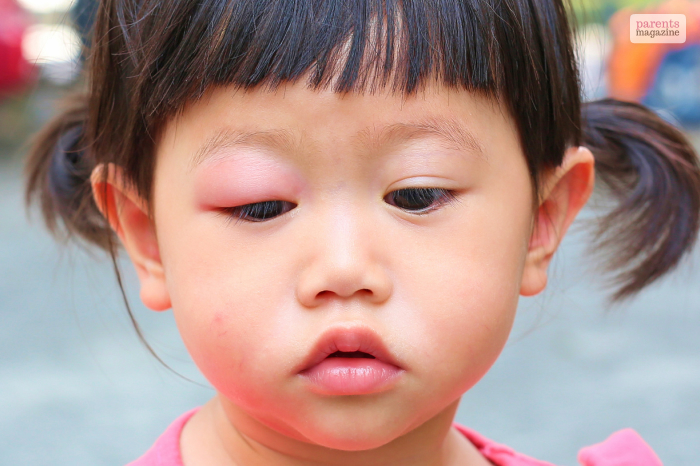 toddler woke up with swollen eye