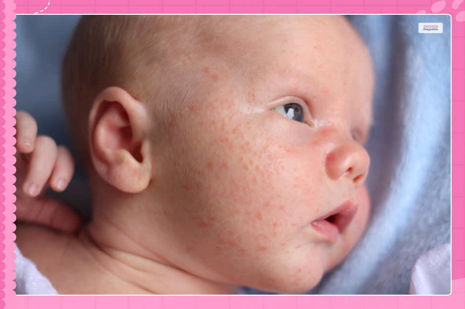 Causes Of Baby Acne