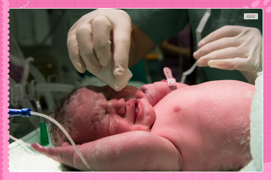 Delivery of a Transverse Baby