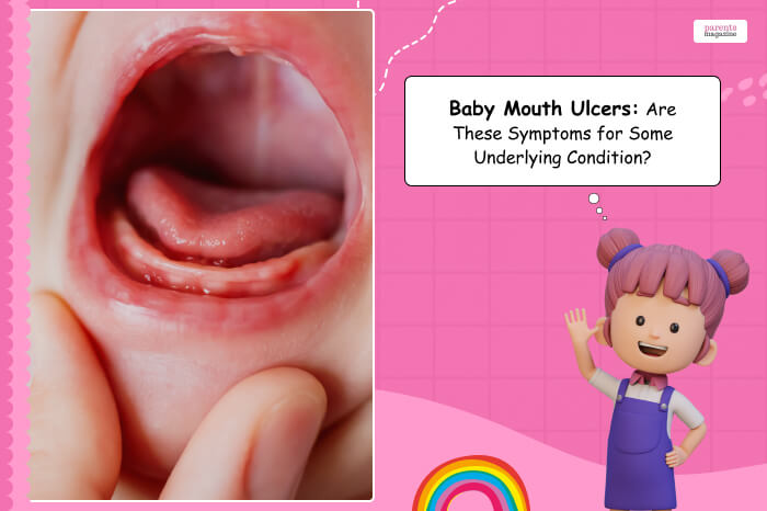 baby mouth ulcer