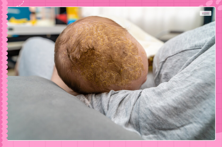 Cradle Cap vs Dry Scalp