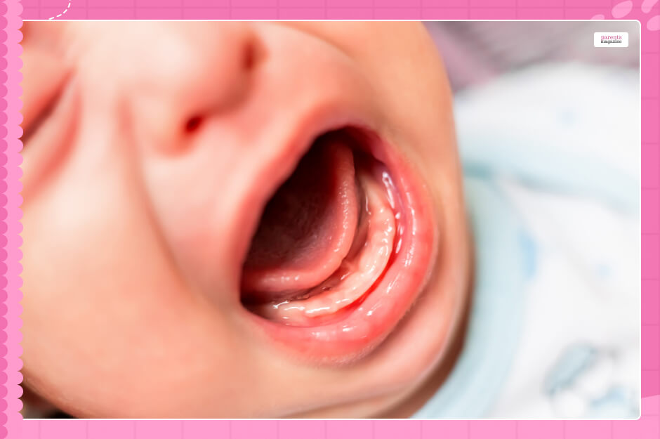 What Are Baby Mouth Ulcers